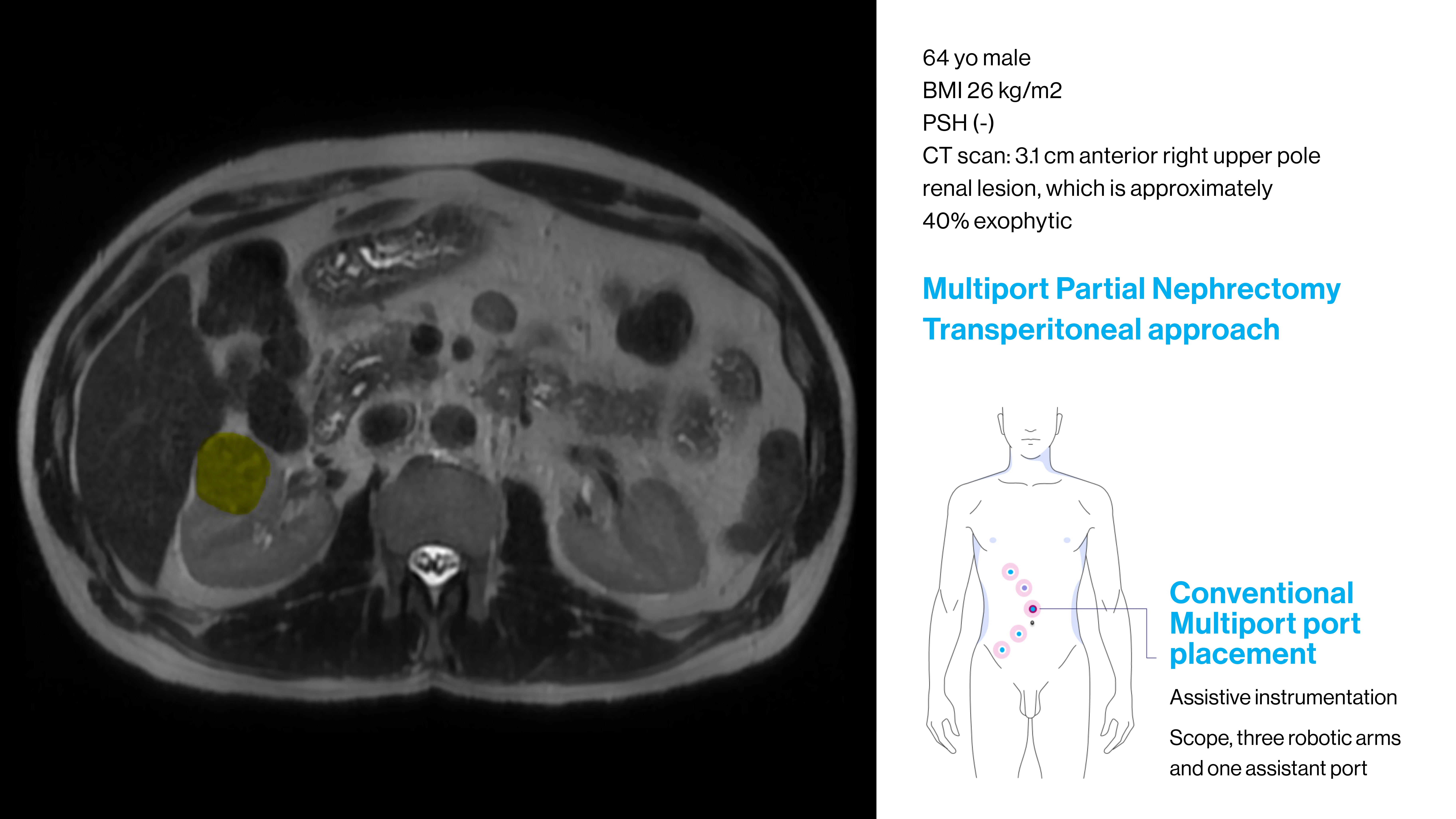 Transperitoneal and Retroperitoneal Port Placement