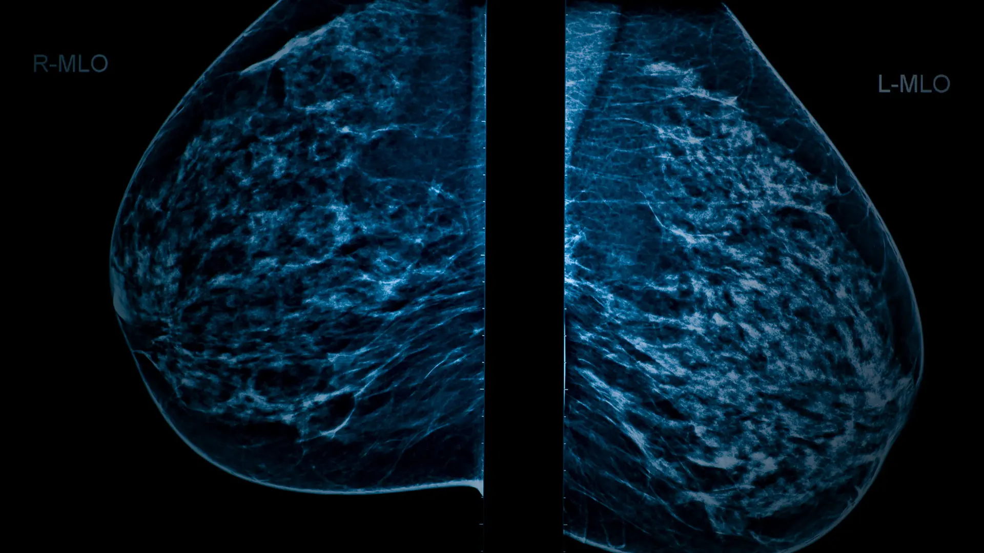 Understanding Breast Density and Its Relationship to Breast Cancer Risk