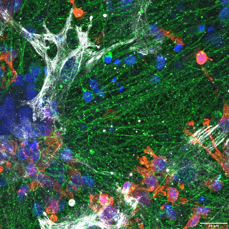 Figure 1. iPSC-derived triculture system. Human induced pluripotent stem cells (iPSCs) are differentiated into neurons (TUJ1, green), astrocytes (GFAP, red), and microglia (IBA1, gray) and cultured together to replicate the multicellular environment of the human brain. This system allows co-culture of astrocytes and microglia with neurons carrying familial AD mutations and their isogenic gene-corrected controls. Credit: Hyo Lee, PhD, and Francesca Garretti, PhD
