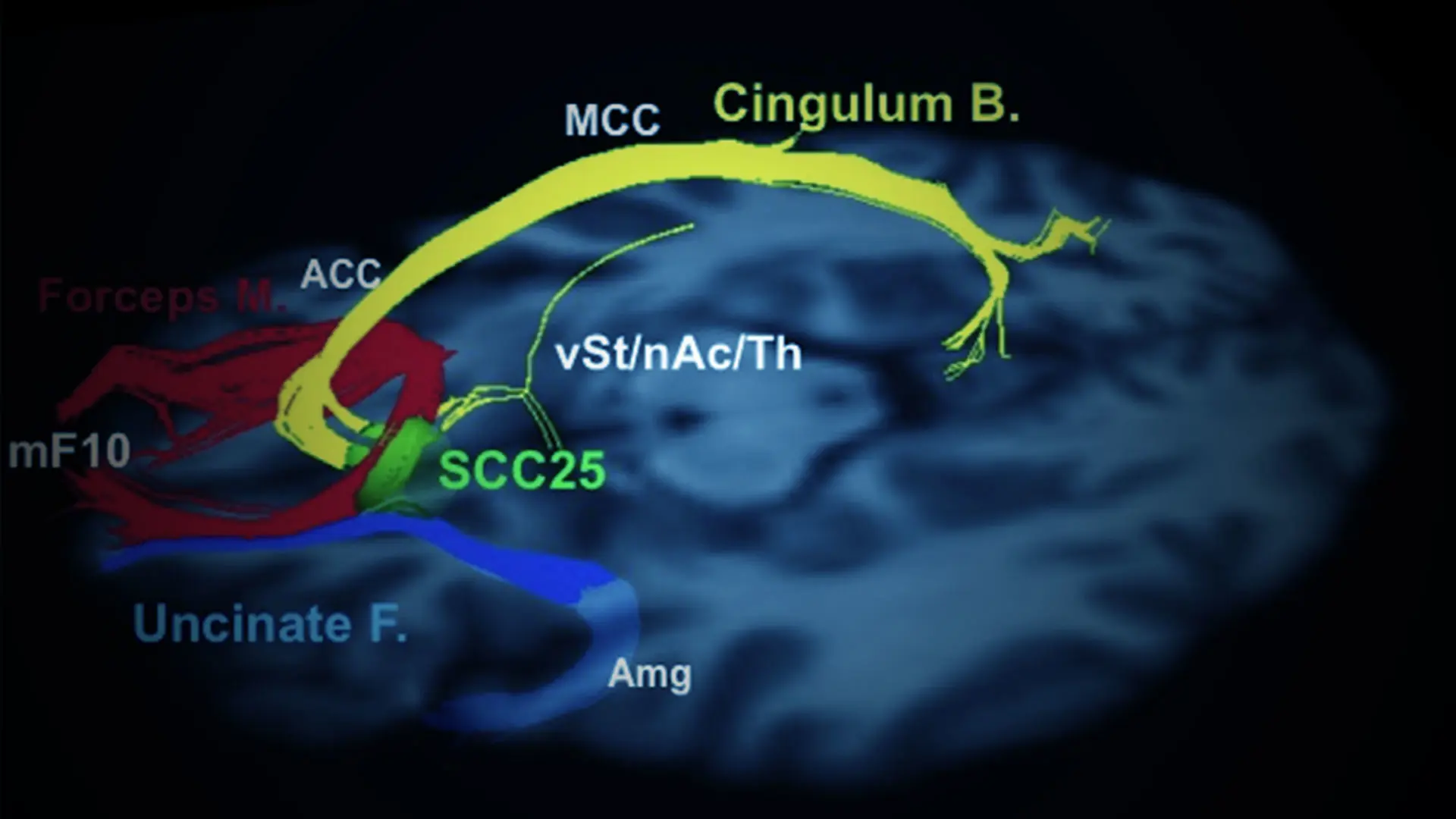 Abbott Initiates Clinical Study to Evaluate the Use of Its Deep Brain Stimulation System to Manage Severe Depression