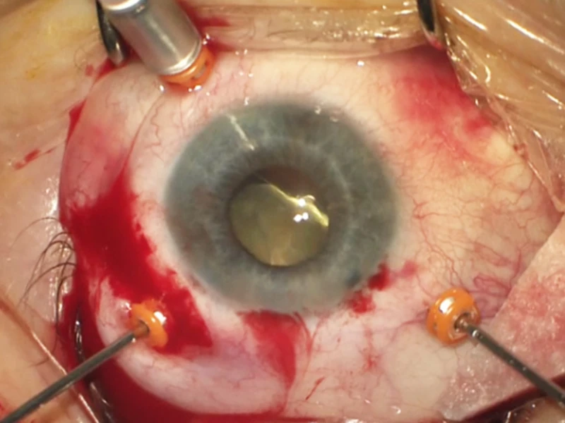 Lens dislocation in the left eye. 