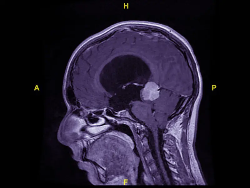 MRI at presentation demonstrating large pineal region contrast enhancing tumor with obstructive hydrocephalus. 





