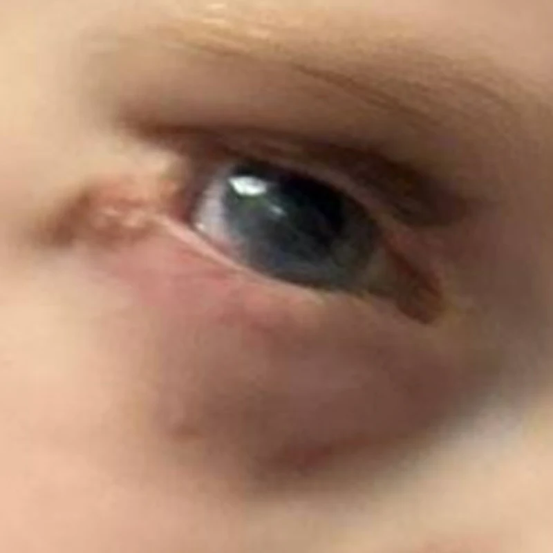 Four months after the second surgery, age 3 years 10 months. The cornea is clear and the lower eyelid is in good position.