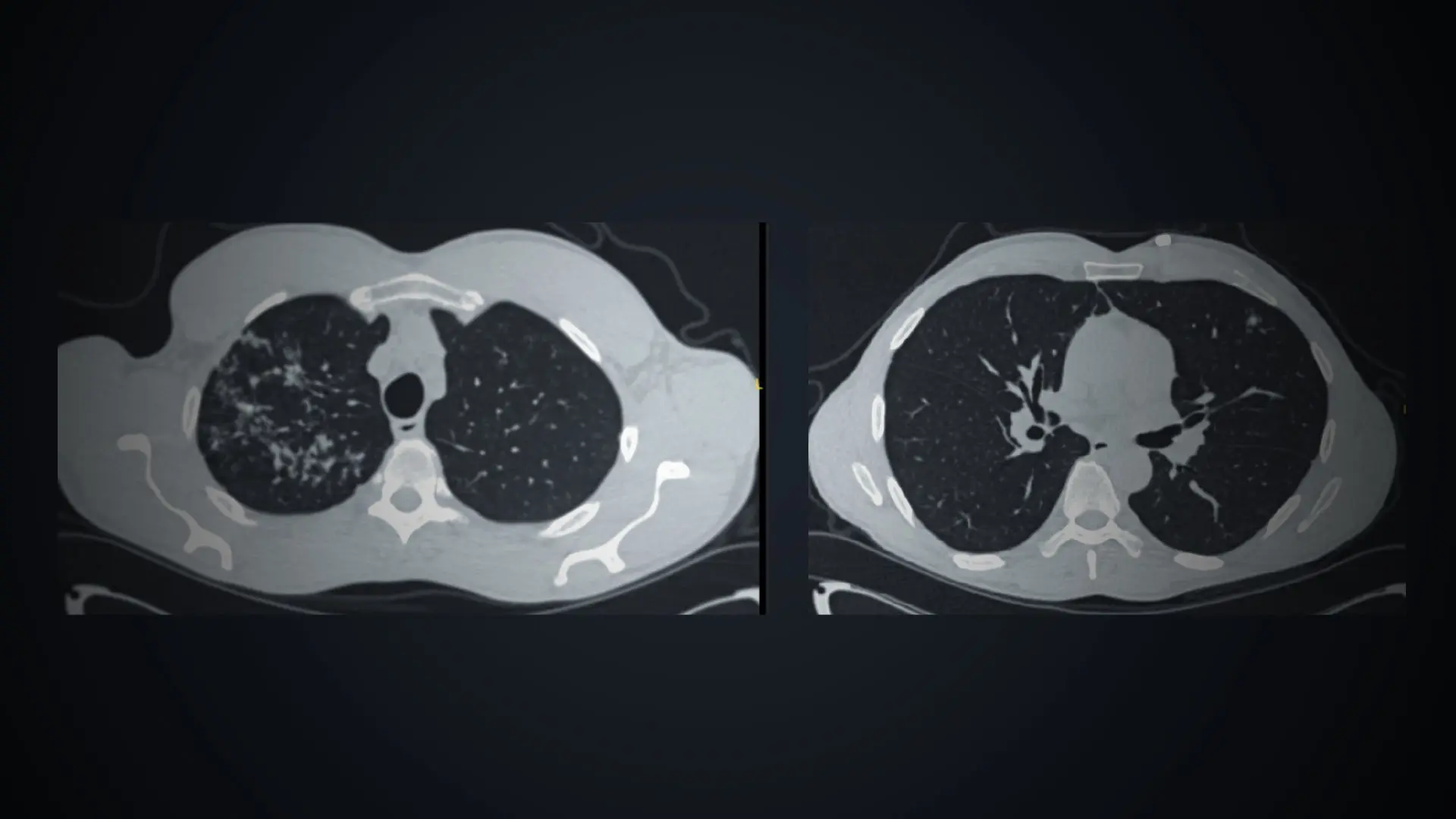 A Systematic Approach to Incidental Lung Nodules