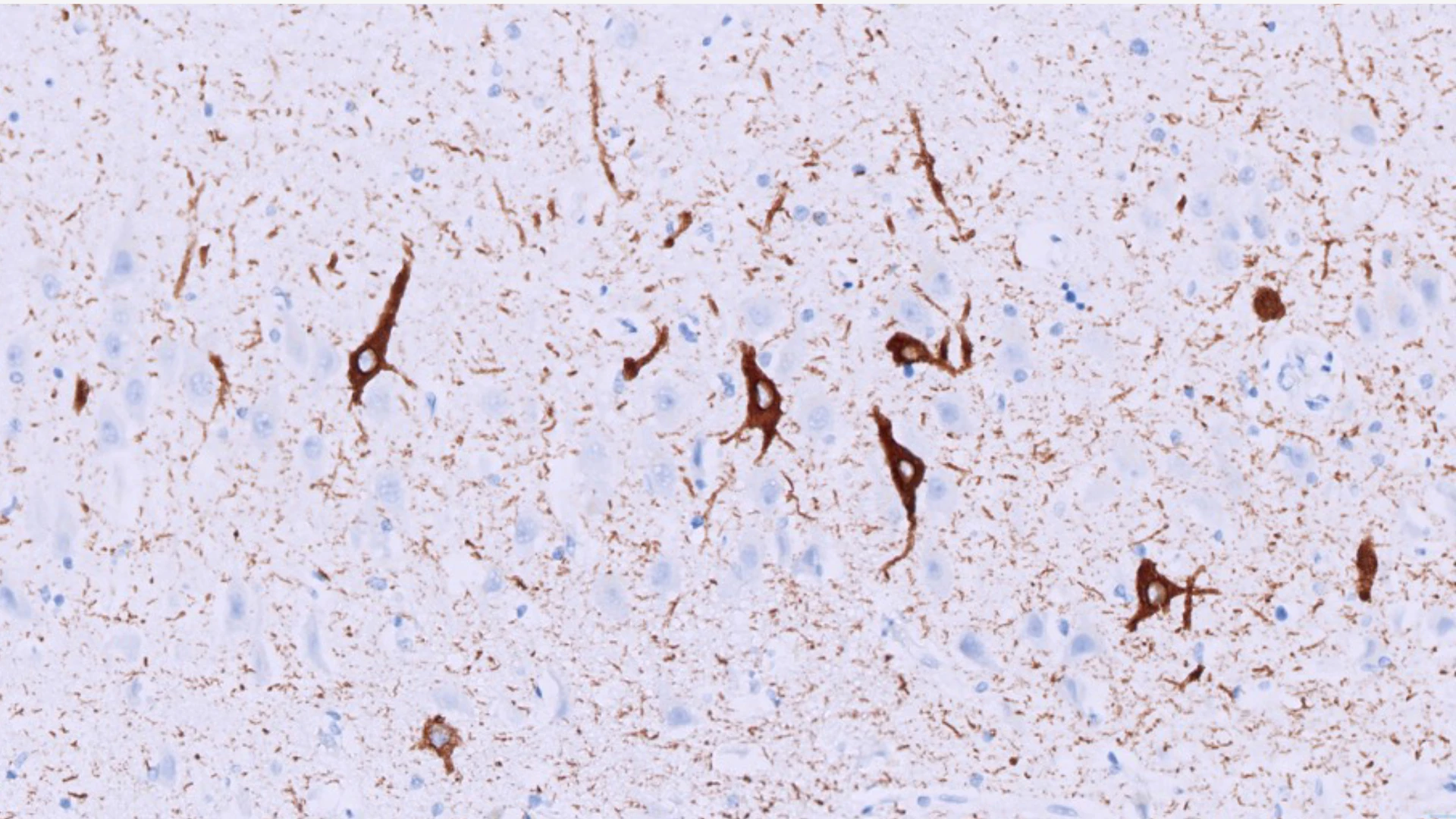 Figure 2: Microscopic image of neurons with tangles (stained in brown) in a patient with primary age-related tauopathy (PART). John Crary, MD, PhD, discovered that these patients who lack amyloid plaques are often misdiagnosed with early Alzheimer’s disease. Brain banks are critical for discovering what causes memory impairment so that precision therapeutics can be developed.
