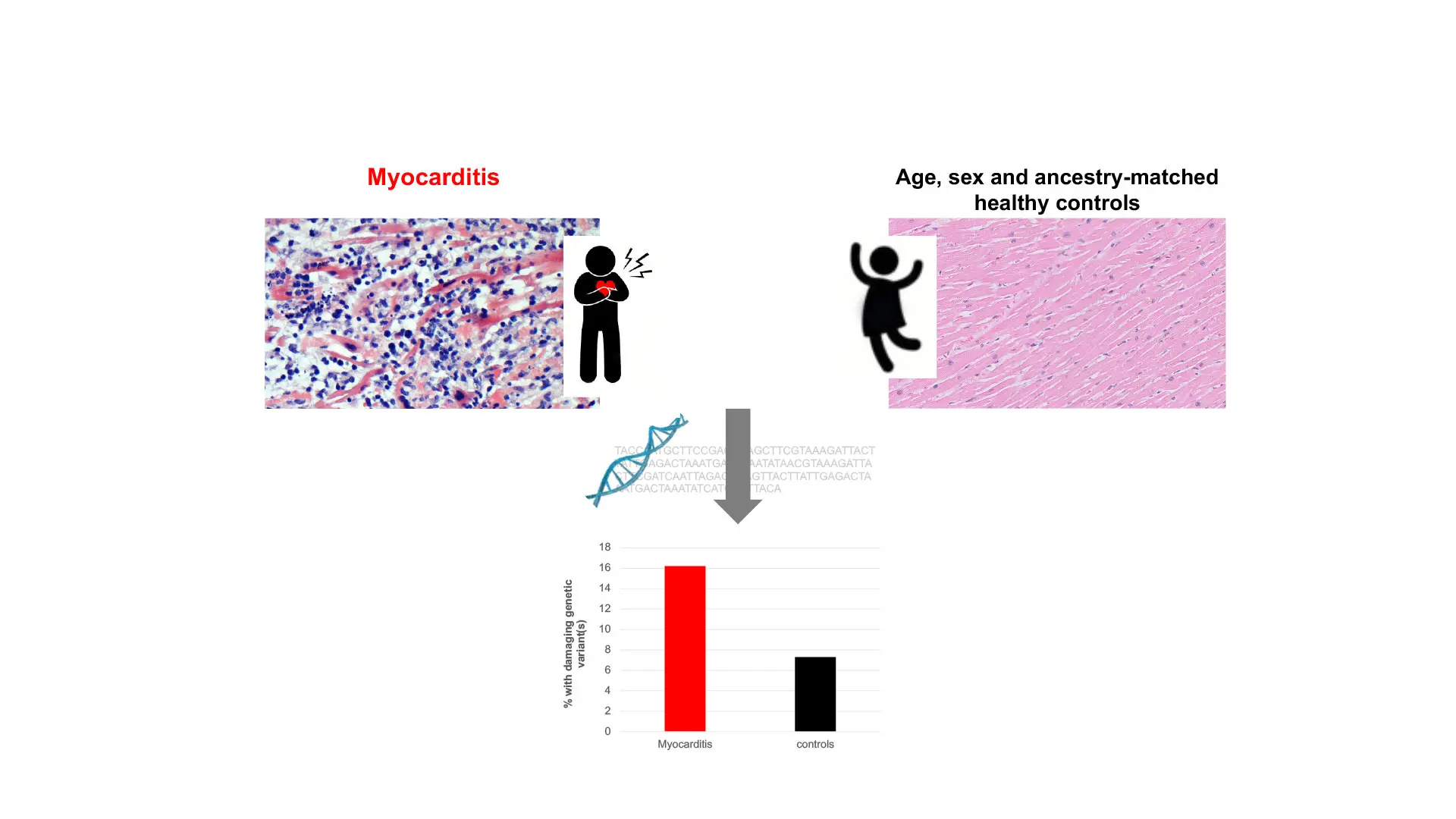 Groundbreaking studies at Mount Sinai have shown that patients presenting with acute myocarditis (AM), presumably precipitated by viral infections, are more likely to harbor damaging variants in cardiomyopathy genes than ancestry- and age-matched controls. This shows that AM can arise due to a predisposition in the host. 