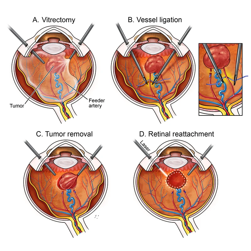 Surgical diagram showing key steps performed by Dr. Landa and Dr. Patel, including tumor removal, vessel ligation, and laser therapy to repair the retinal detachment (Gregory © 2025 Mount Sinai Health System)