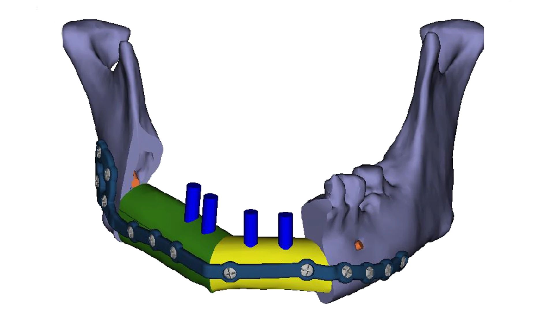 Planned reconstruction of the jaw using a vascularized fibula free flap (green and yellow) and dental implants (blue).