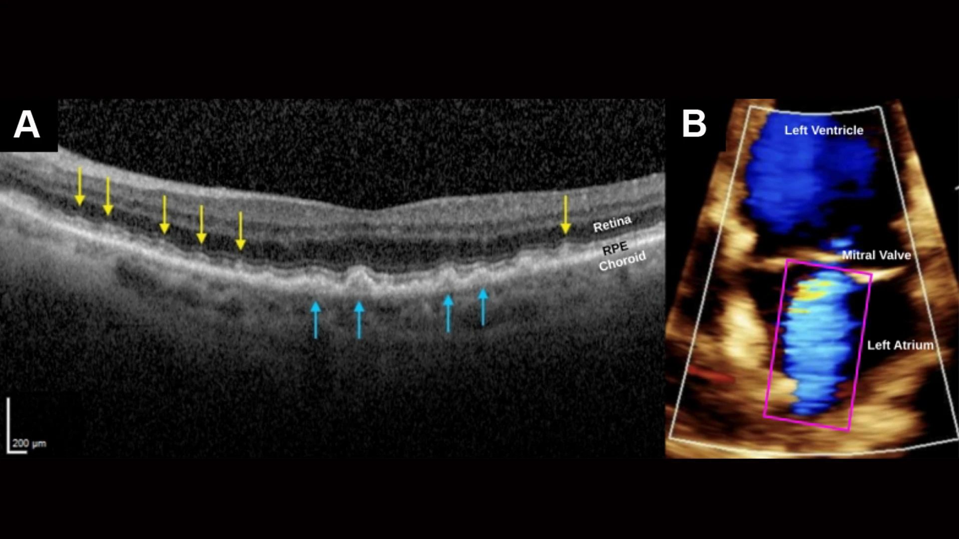 SDDs caused by severe cardiac valve disease. (A) SD-OCT scan, right eye, shows myriad SDDs (yellow arrows) above the RPE and several drusen (blue arrows) beneath the RPE in a patient with severe mitral valve regurgitation and compromised cardiac output. The insufficient ocular perfusion downstream then results in the SDDs. The left eye was similar. (B) A color doppler transthoracic echocardiogram of the left ventricle during systole, showing markedly reduced cardiac index, 1.87 L/min/m2, normal range 2.5-4.0, and severe mitral valve regurgitation. Left atrium shows turbid jet of arterial blood flowing retrograde from the left ventricle.