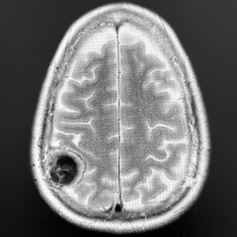 Top Left. Axial T2-weighted brain MRI showing a 4-cm right parietal meningioma compressing the postcentral gyrus (hand and arm primary somatosensory cortex) in a patient who originally presented with a seizure involving sensory and motor changes on the left side of the body.