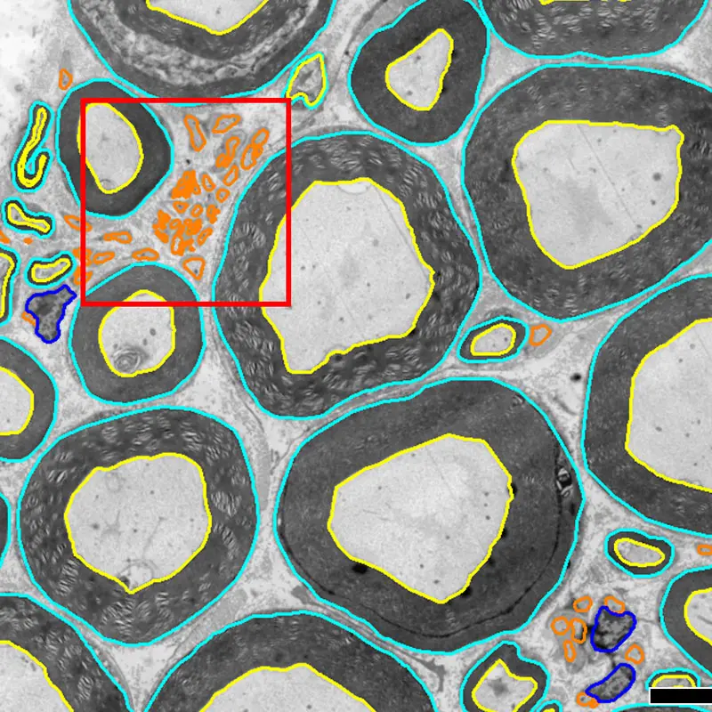 Transmission electron microscope images of lumbosacral ventral roots in rhesus macaques. Computer-supported analysis allows for segmentation of myelinated and unmyelinated axons. Boxed area shown at higher magnification in next image. Scale: 10 µm











