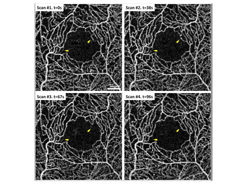 Innovative New Role for OCT Angiography Against Sickle Cell Retinopathy