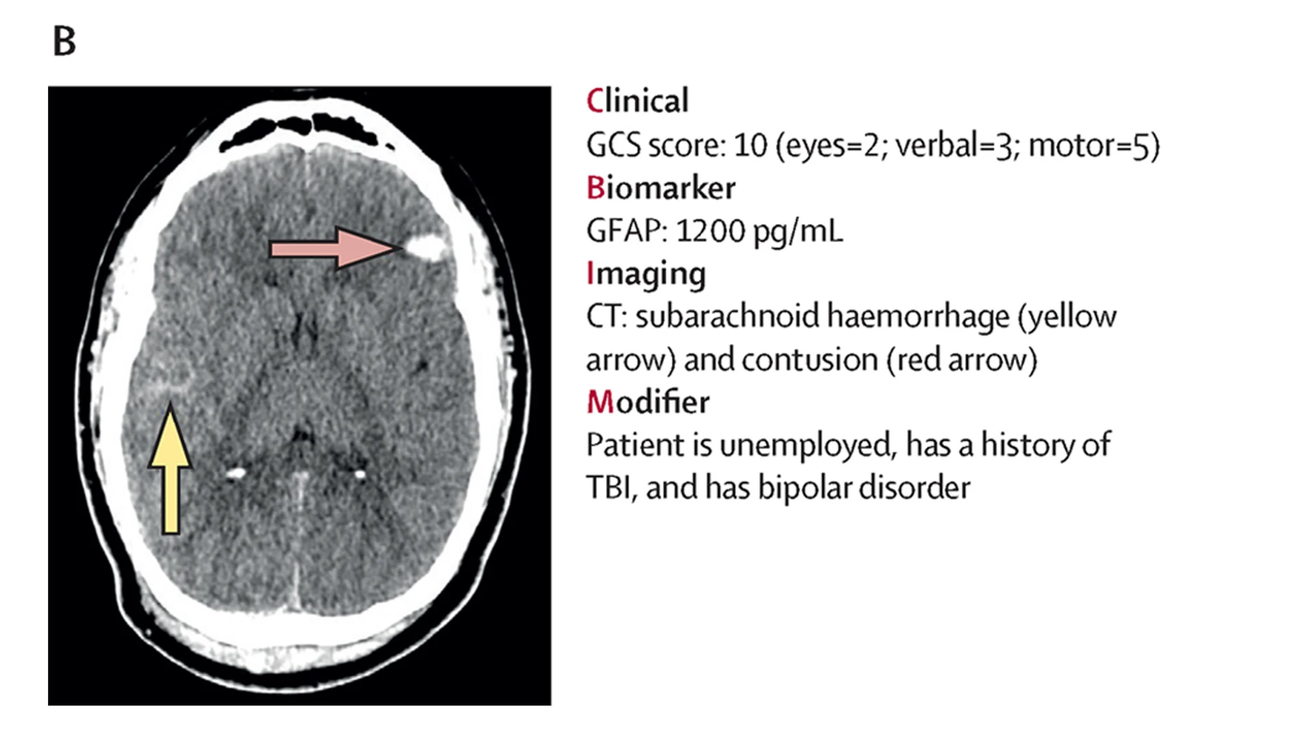 A second case study of the CBI-M framework enhancing care. The CT scan shows a female, aged 48 years, injured by a ground-level fall. She was classified as having moderate TBI on the basis of GCS score. The patient presented with loss of consciousness, and the biomarker concentration and CT scan were abnormal. Because of the presence of traumatic intracranial abnormalities and modifiers, the patient had a high risk for persisting disability. Follow-up care to support the patient's recovery is indicated, and referral to additional services—e.g., mental health services, social services, and care coordination programs—might help the patient to manage modifiable risk factors for poor outcome, such as mental health.
