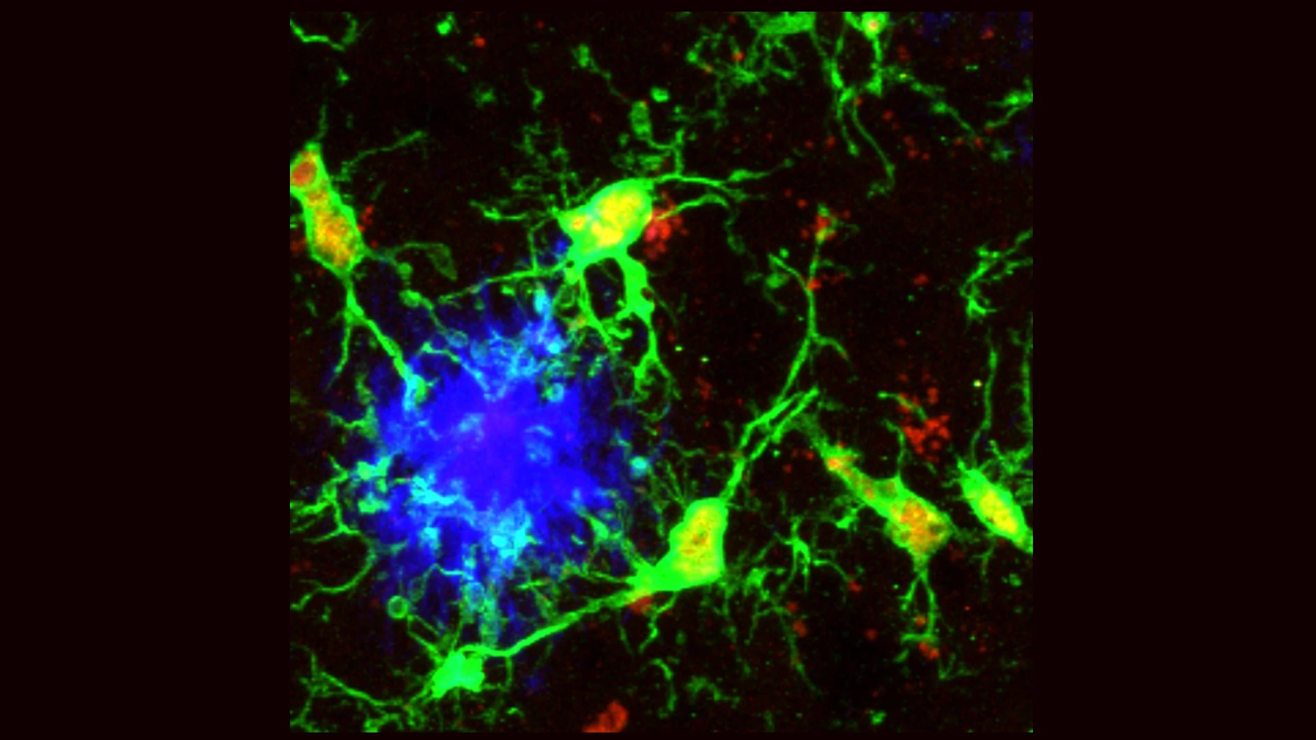 Figure 3 (above and below). Microglia sensing and attacking amyloid plaques in the mouse and human brain. Microglia (green) sensing and responding to aggregated beta-amyloid plaques (blue) in the mouse cortex (above) or amyloid plaques (brown, below) in human diseased brain tissue (blue cell nuclei staining).