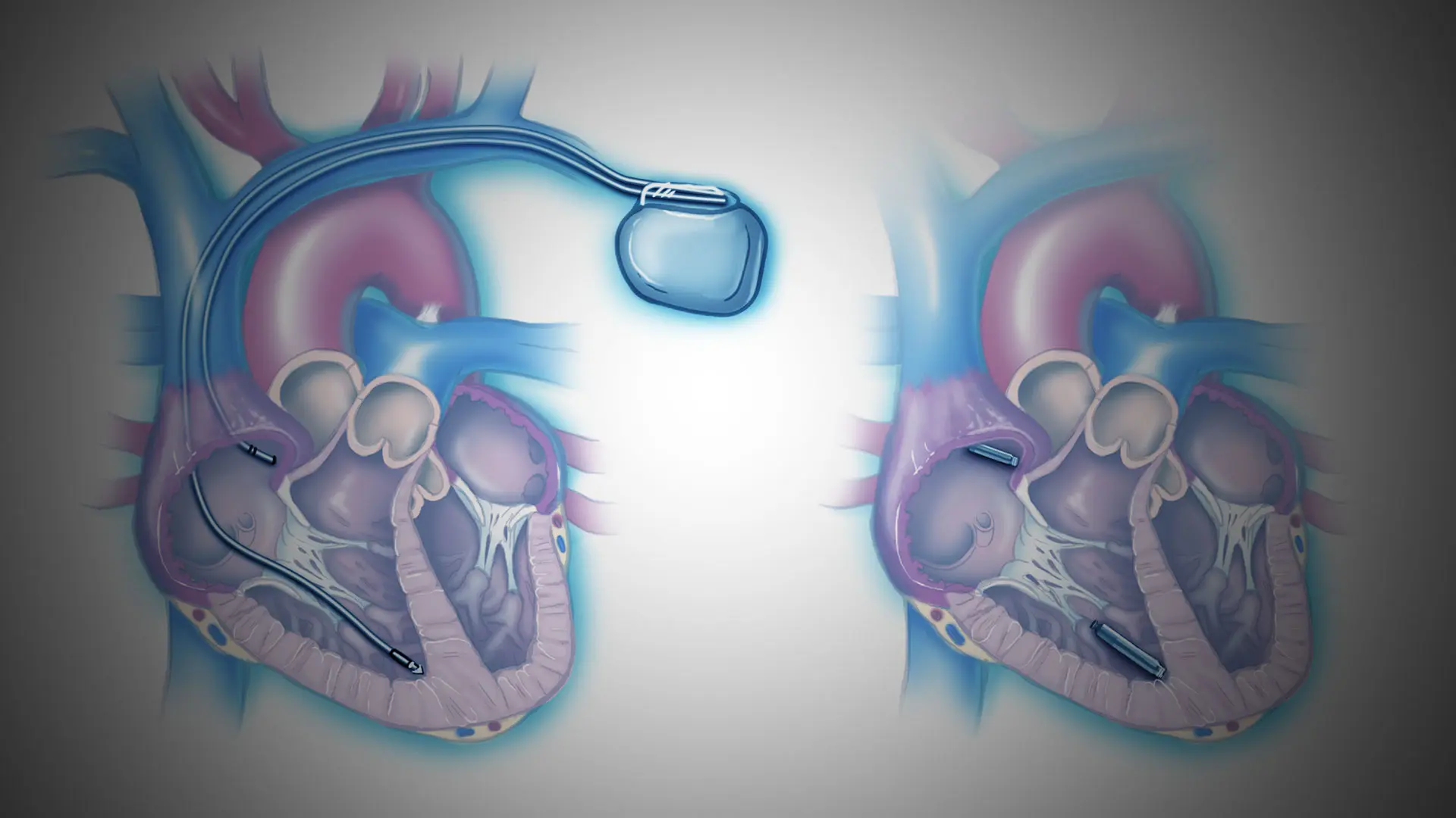 Study of Single-Chamber Leadless Pacemaker Sets Stage for Two-Chamber System