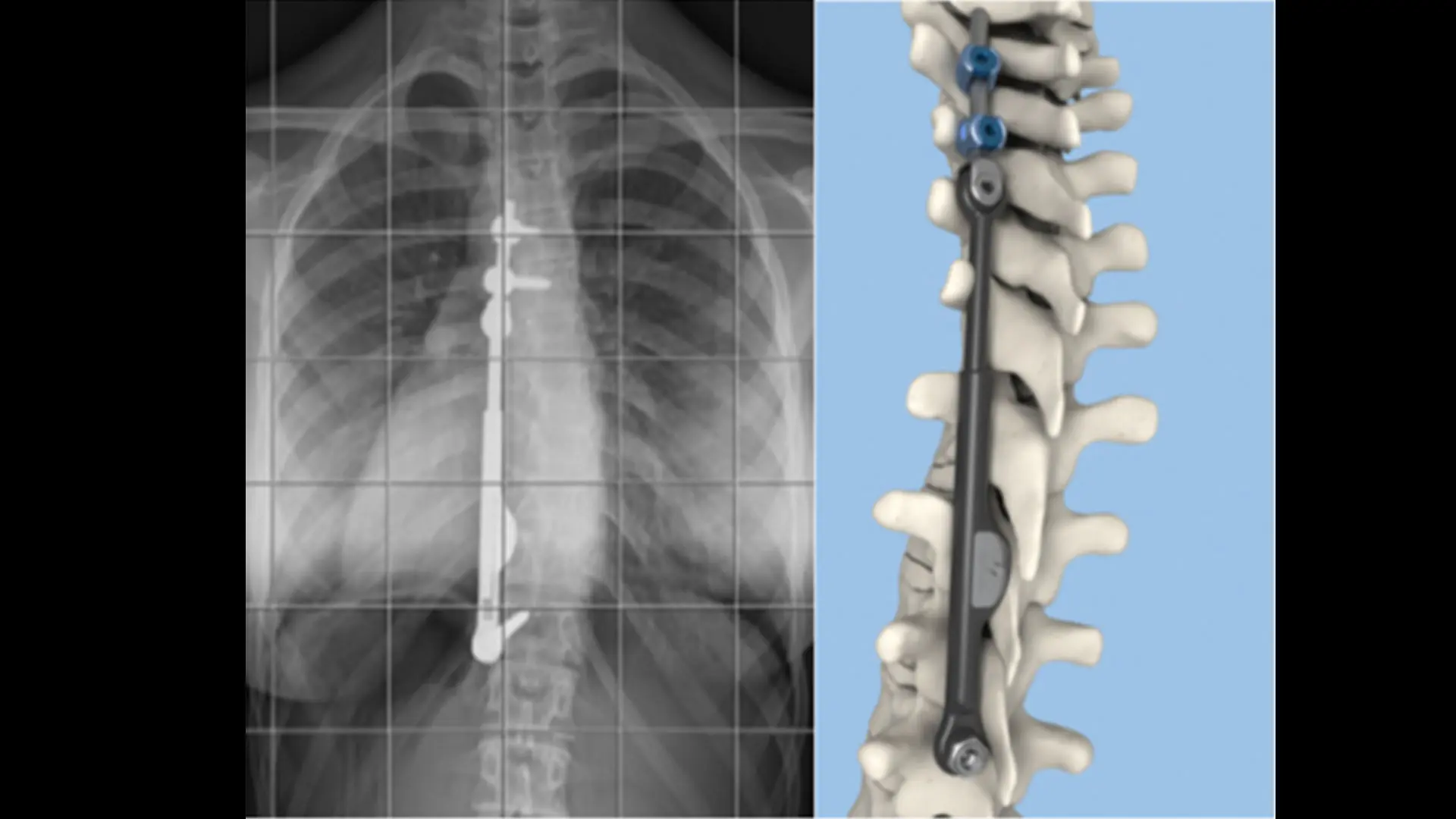 The ApiFix System is implanted via a posterior or back approach and maintains a good deal of patient's natural flexibility through a self-adjusting rod mechanism that allows for additional post-operative correction. 