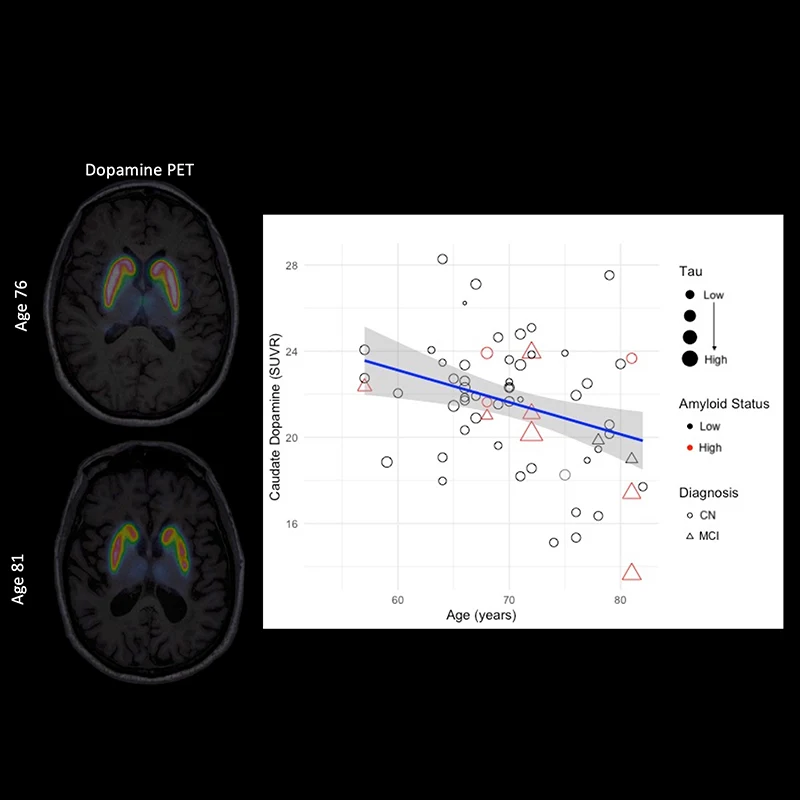Figure 2. Dopamine PET images showing D2/D3 receptor binding in caudate and putamen. Graph illustrates age-related decreases in receptor binding, distinct from amyloid, tau, or diagnosis.