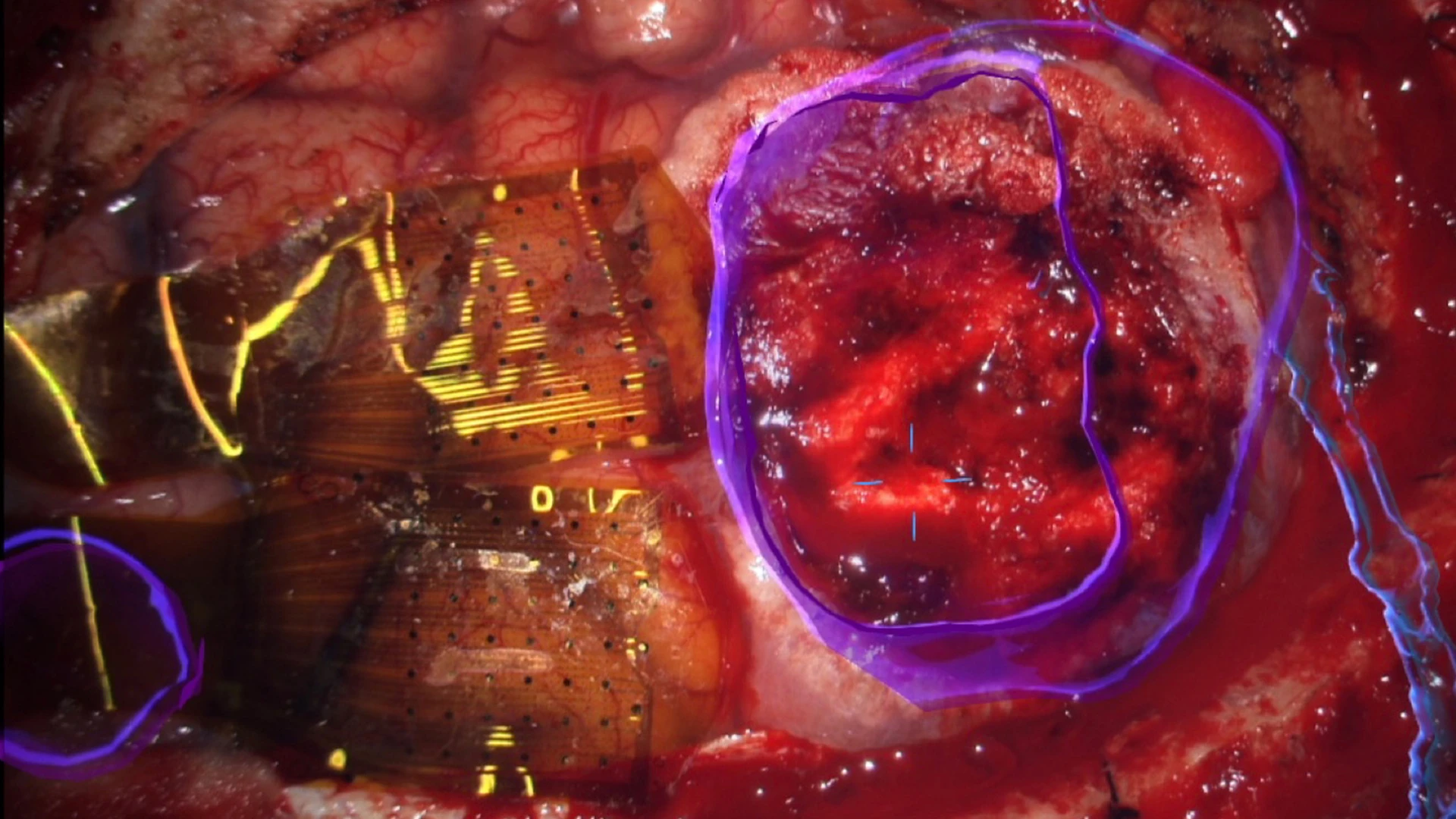 Top Right. Operative field as seen through an operative microscope, with augmented reality overlay in blue to highlight the tumor, right. Two 1,024-electrode arrays, totaling 2,048 microelectrodes, are shown in position straddling the central sulcus, including the precentral (motor) and postcentral (somatosensory) gyri anterior to the tumor, left.  