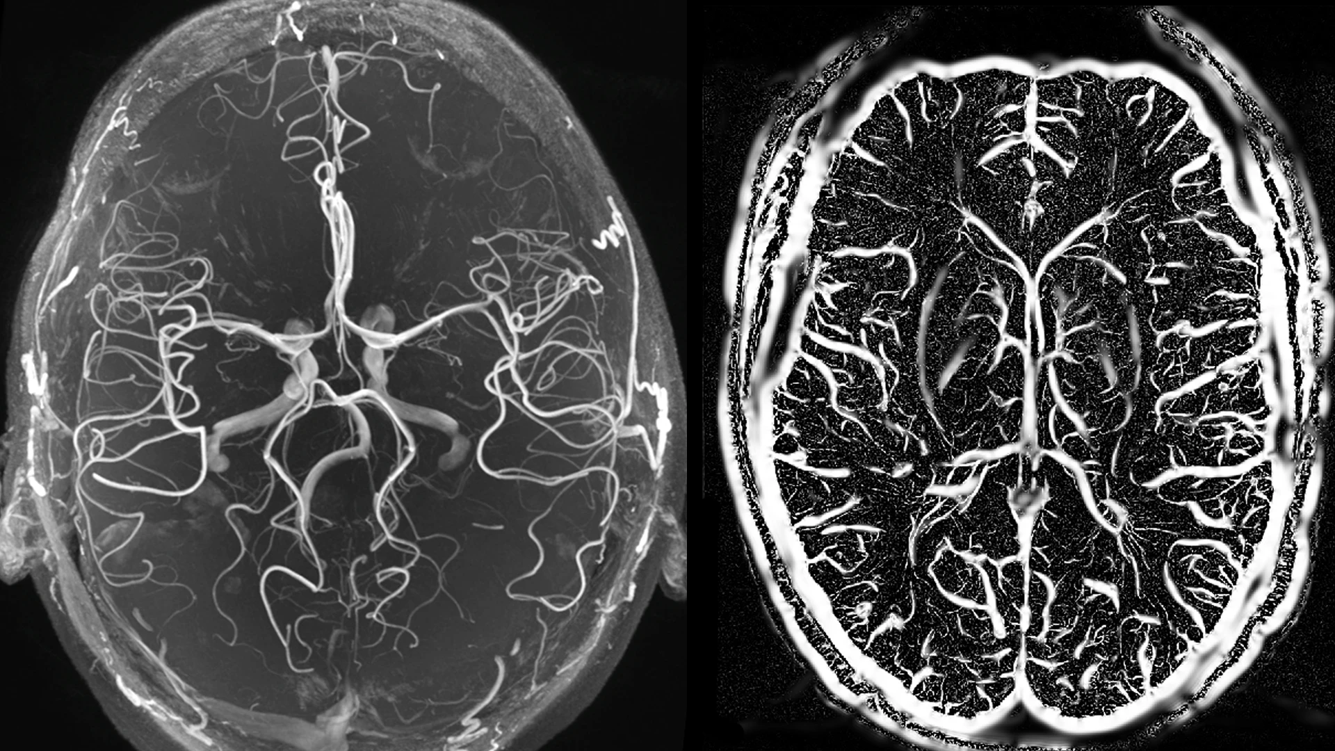 Figure 2. 7-T time of flight (TOF) image showing arteries (left) and SWI segmentation showing veins (right). This depicts 7-T TOF imaging and susceptibility-weighted imaging (SWI) allow visualization of vascular abnormalities that may underlie structural lesions.