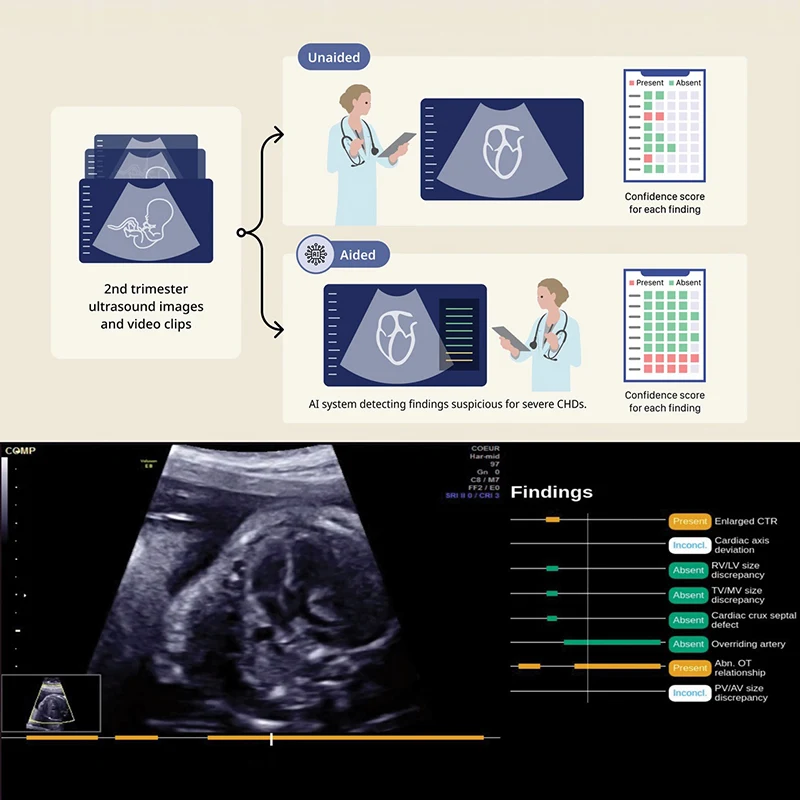 A. In this multireader, multicase study, obstetrician-gynecologists and maternal-fetal medicine specialists interpreted entire second-trimester fetal ultrasound examinations to identify the presence or absence of eight morphologic findings suspicious for severe congenital heart defects (CHDs), along with confidence scores, both aided and unaided by the AI-based software. B. Example annotated cine clip generated by the AI-based software. The AI-based software detects each finding as present (orange), absent (green), or inconclusive (white) and indicates times in the cine clip at when the finding can be seen as present or absent. Vertical bar represents the current frame. CTR, cardiothoracic ratio; RV/LV, right to left ventricular; TV/MV, tricuspid to mitral valve; Abn. OT, abnormal outflow tract; PV/AV, pulmonary to aortic valve.  