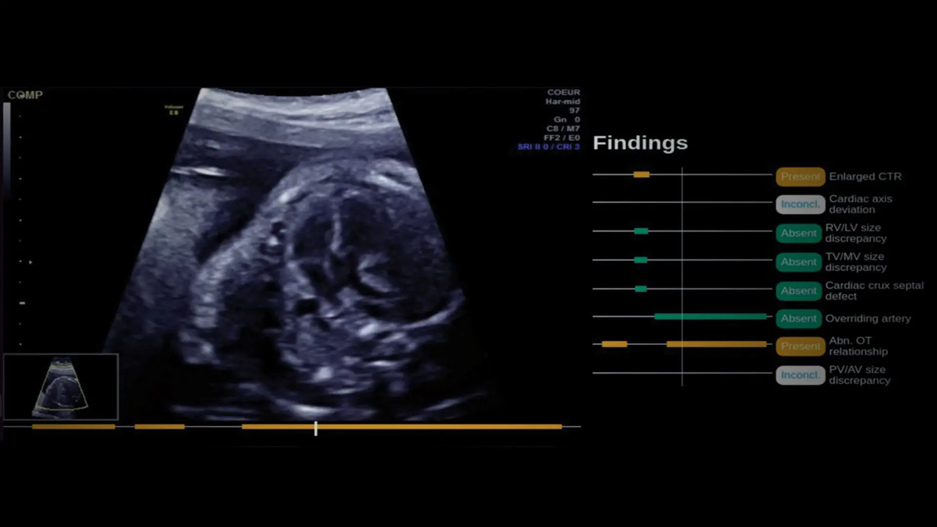 Mount Sinai Obstetricians First in New York City to Use AI Tool That Enhances Fetal Screenings for Congenital Heart Defects