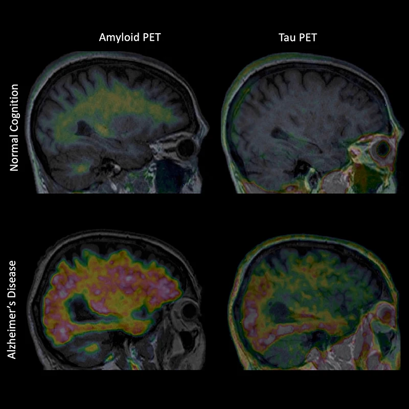 Figure 1. Amyloid and tau PET images from an older individual with normal cognition, and from a patient with AD.