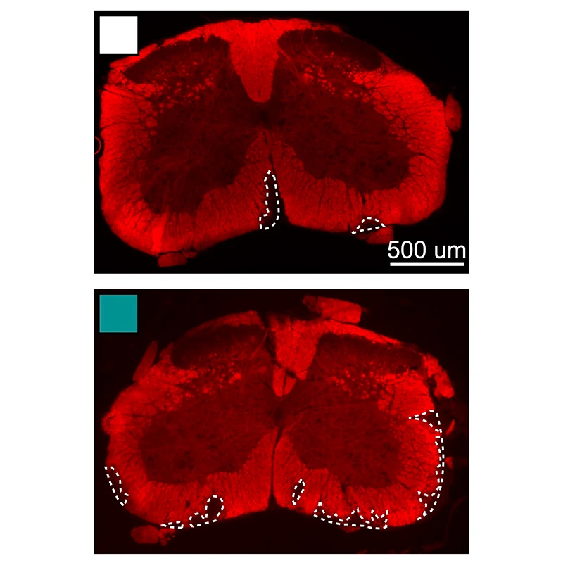 Demyelination in the spinal cord of a mouse with MS and cardiometabolic syndrome.