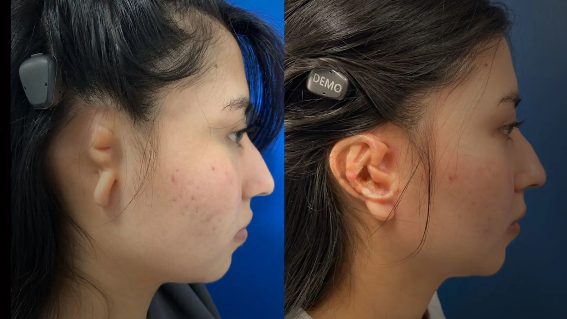 Providing Comprehensive Care for Patients With Microtia and Atresia