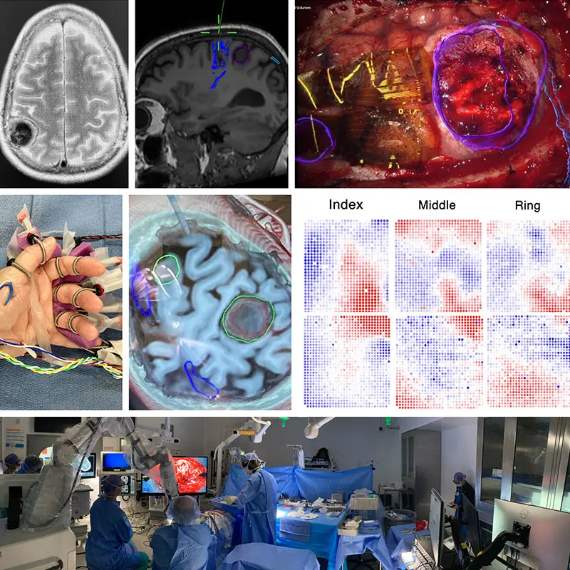 Figure 1. This composite figure illustrates intraoperative mapping of primary somatosensory cortex at high resolution using 2,048 surface microelectrodes.