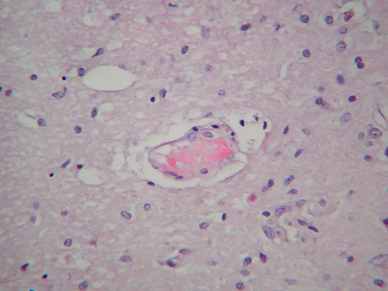 Figure 2. COVID-19-associated microangiopathy in the brain. 



