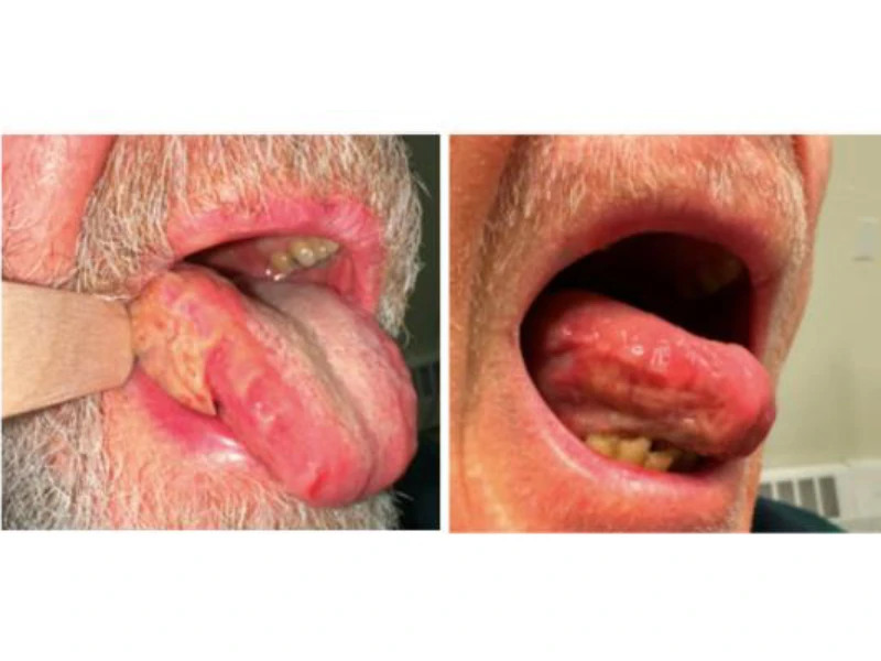 A patient with lateral tongue squamous cell carcinoma before (left) and after (right) neoadjuvant induction chemotherapy, shown prior to surgery. Tumor response reduced the extent of surgical resection required and improved clinical outcomes. 