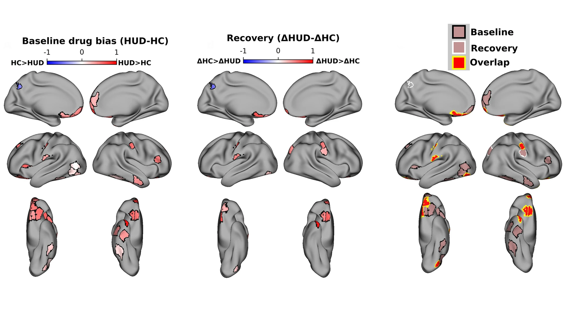 Participants with heroin use disorder were given a baseline fMRI scan prior to treatment, and the drug-biased responses in the brain were noted (left). Following treatment, the same participants were scanned again for drug-biased responses (center). Researchers saw not only a decrease in drug-biased responses, but also recovery in other brain regions (right).