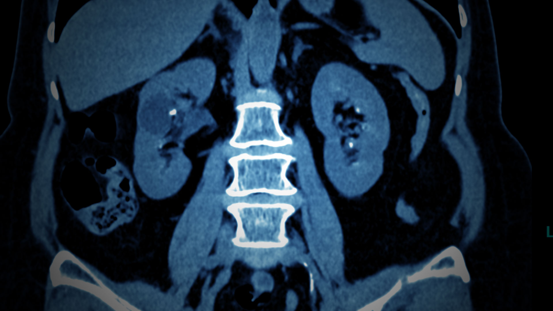 Ureteroscopies Without Wires and Stents Could Be the Field's