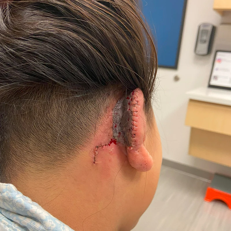 A natural appearing ear is one that has recognizable structures that are well elevated away from the skull. Skin graft discoloration fades over time.