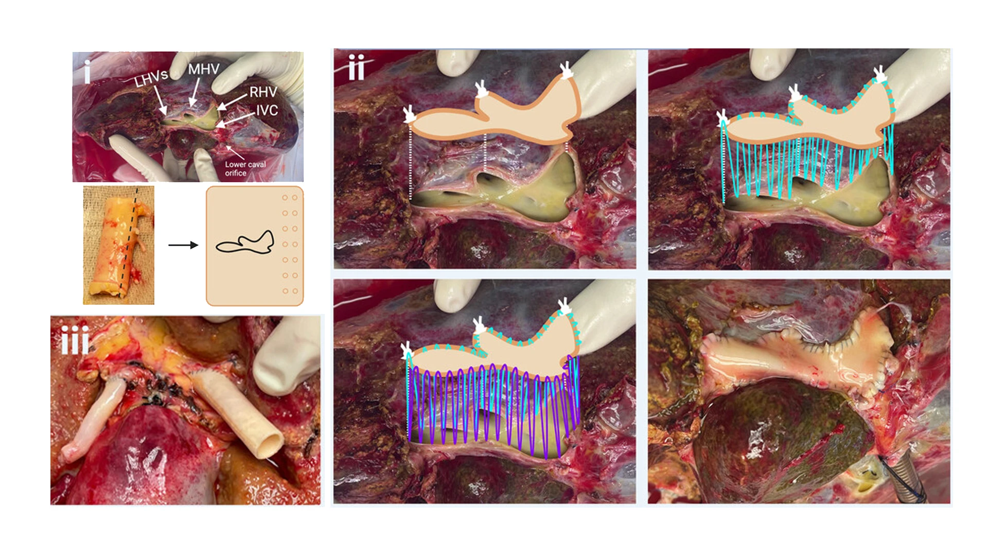 In a related study published on Artificial Organs, the research team found validation for using closed-circuit normothermic machine perfusion as a platform to study organs for mechanisms of disease and applied therapeutics. The technique involved reconstructing a singular venous outflow tract to make the hepatectomized livers compatible with the perfusion machine, by suturing a graft covering various hepatic veins and the inferior vena cava (images I through III).