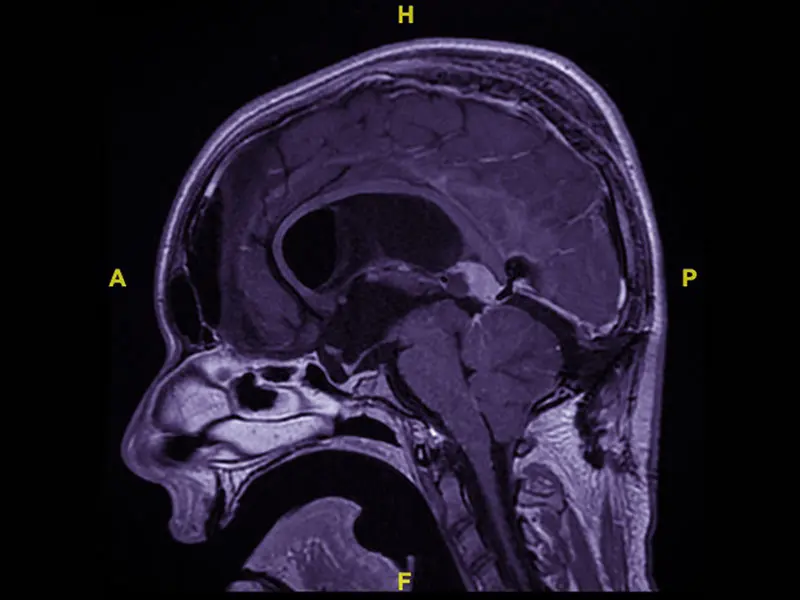 MRI after first resection: This sagittal T1 post-contrast image demonstrates the residual tumor after infratentorial supracerebellar approach for partial resection. The tumor is centered in the posterior roof of the third ventricle, under the splenium of the corpus callosum.