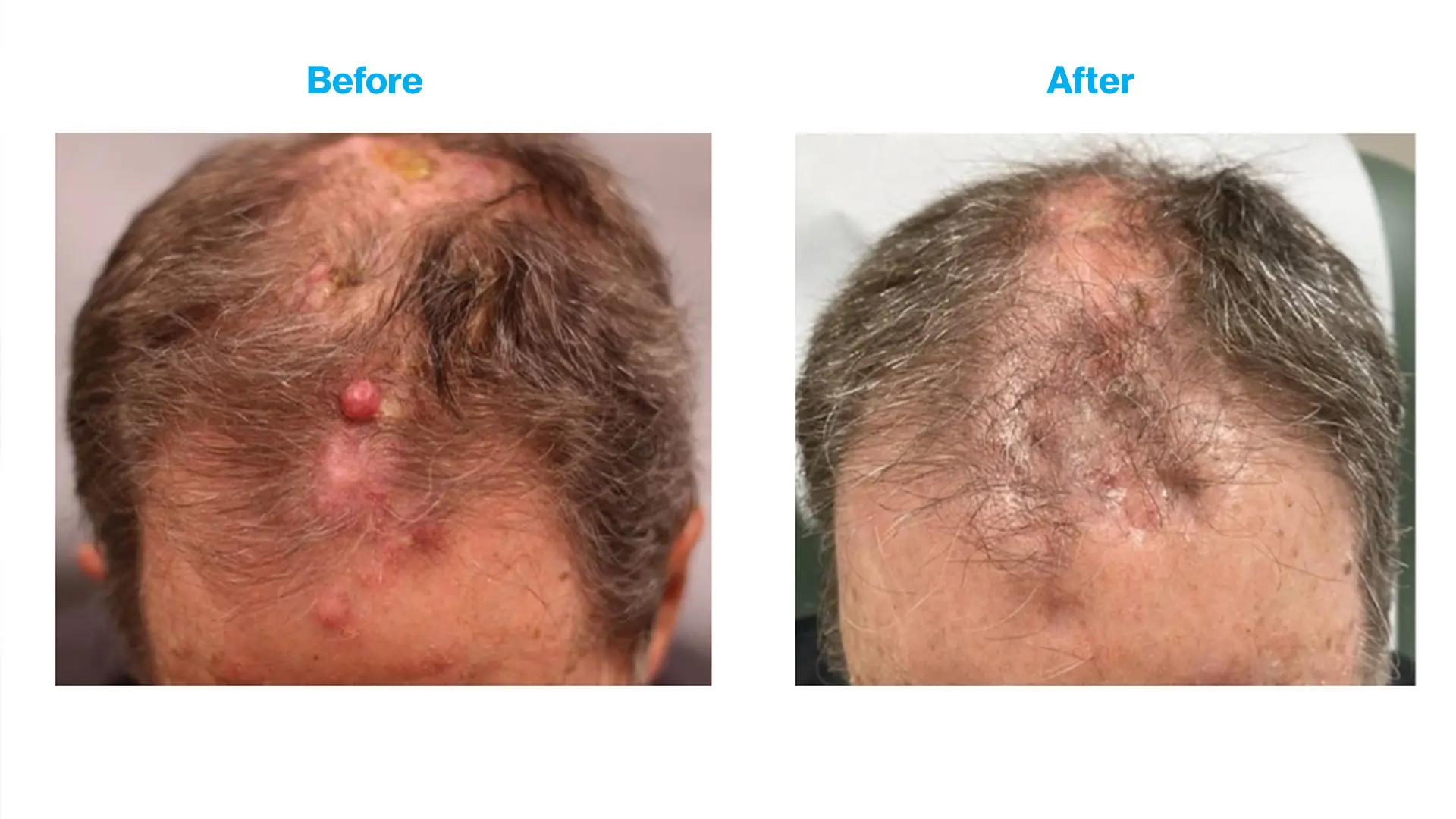 Before and after photos from the first patient to complete the clinical trial. The bumps on the patient’s scalp represent skin metastases.