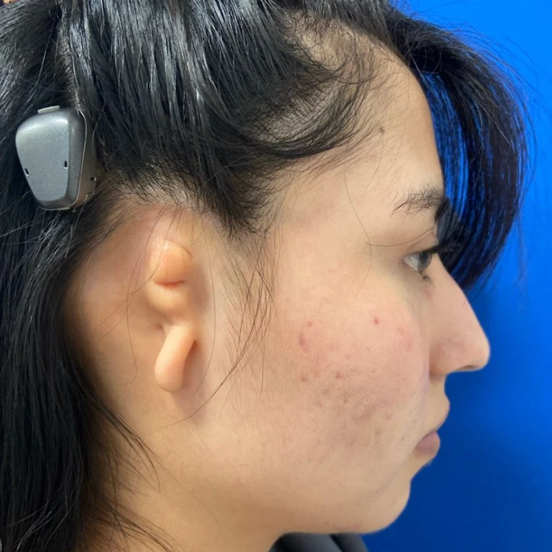 Preoperative photograph of a patient with a lobular-type microtia. She previously had a bone-anchored hearing aid placed by neurotologist Zachary Schwam, MD, Assistant Professor, Otolaryngology, Icahn School of Medicine.