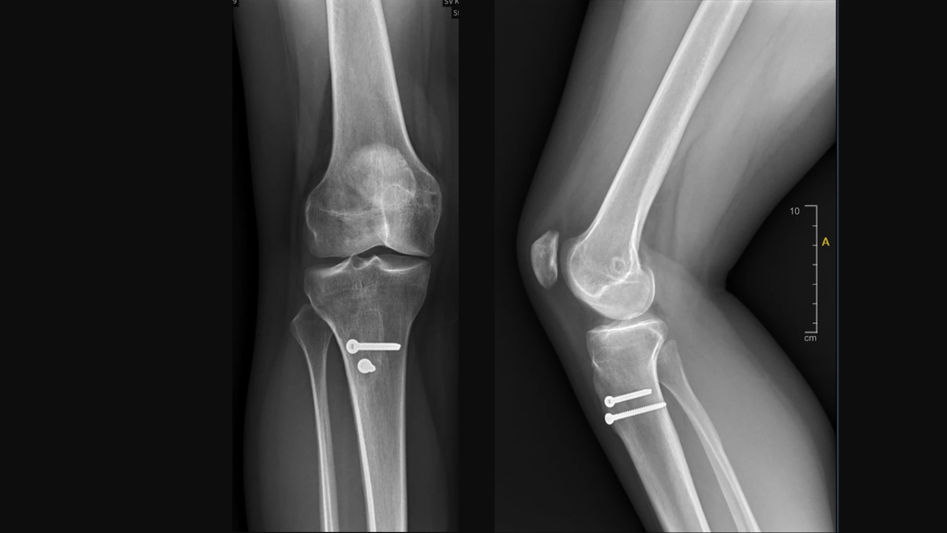 Anterior, posterior, and lateral view of the distalizing and anterior medializing tibial tubercle osteotomy and MPFL reconstruction.