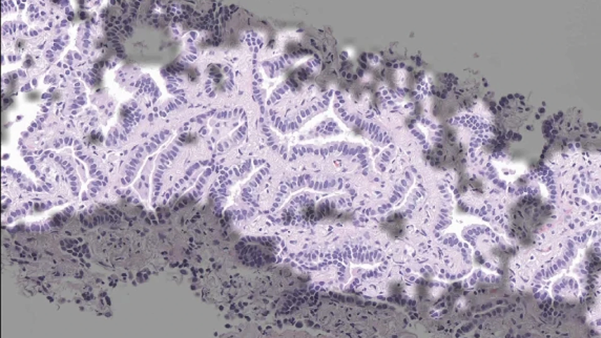 AI-Based Pathology Model Predicts EGFR Mutations in Lung Adenocarcinoma