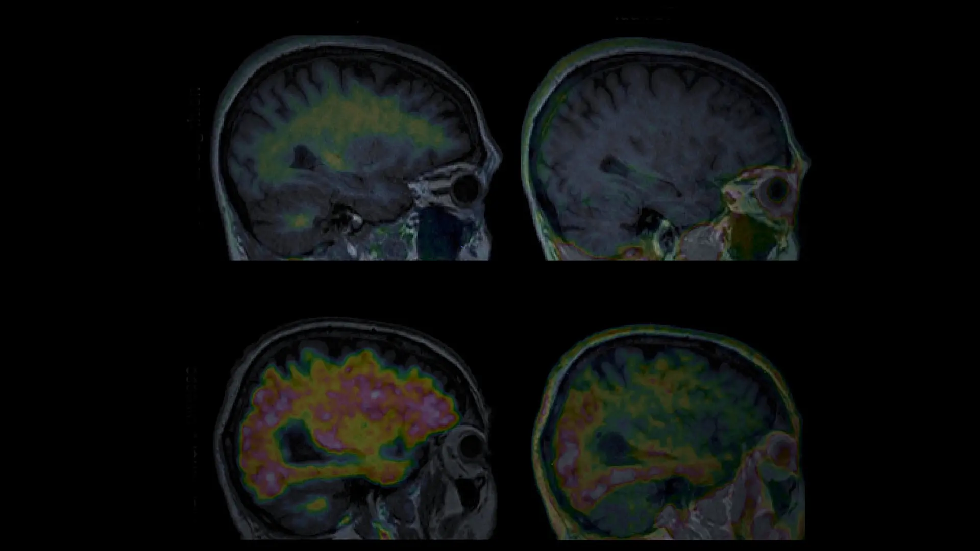 Using Imaging and Biomarkers to Detect Alzheimer’s Disease Before Symptoms Arise