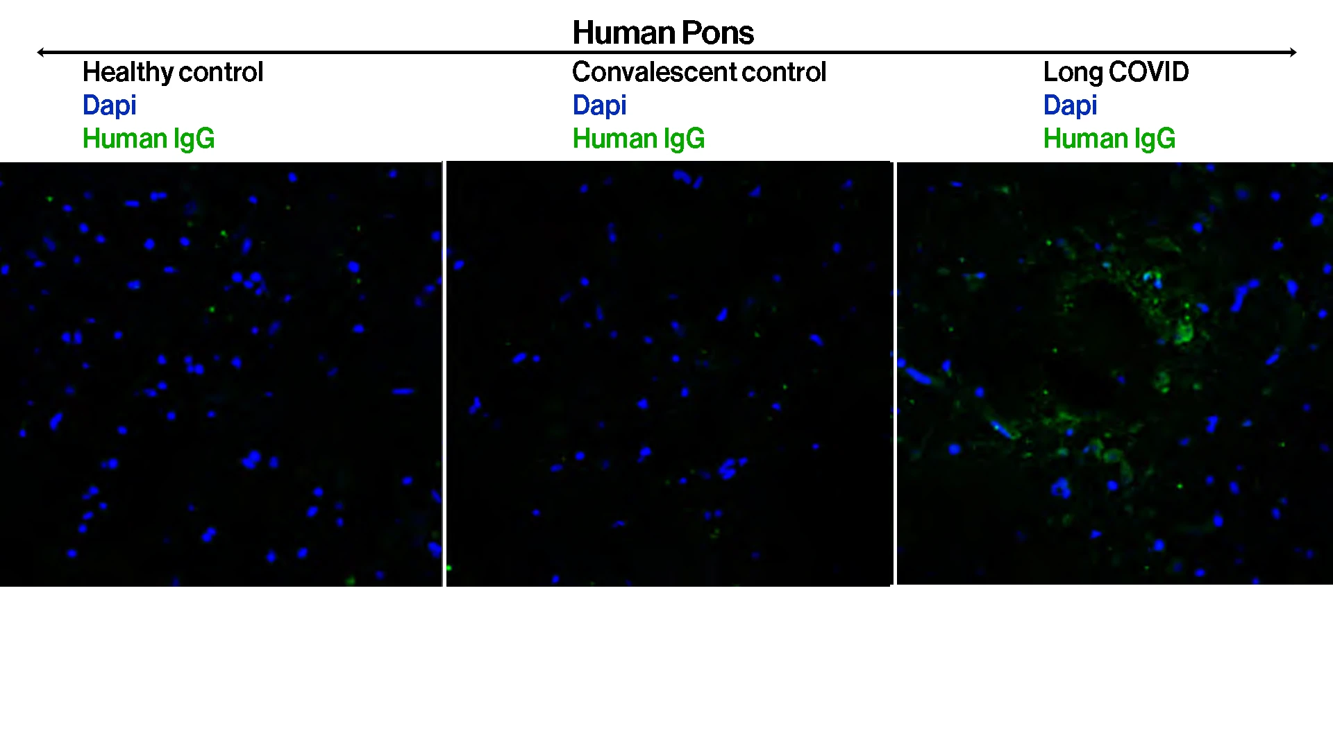 To evaluate if study participants had functional autoantibody profiles that could provoke their
Long COVID-associated neurological symptoms, researchers purified IgG from plasma and performed immunofluorescence analyses using healthy human tissues. Participants' IgG showed reactivity against human pons—seen as green fluorescence in the slides—as well as in various mice tissue as part of protocol.