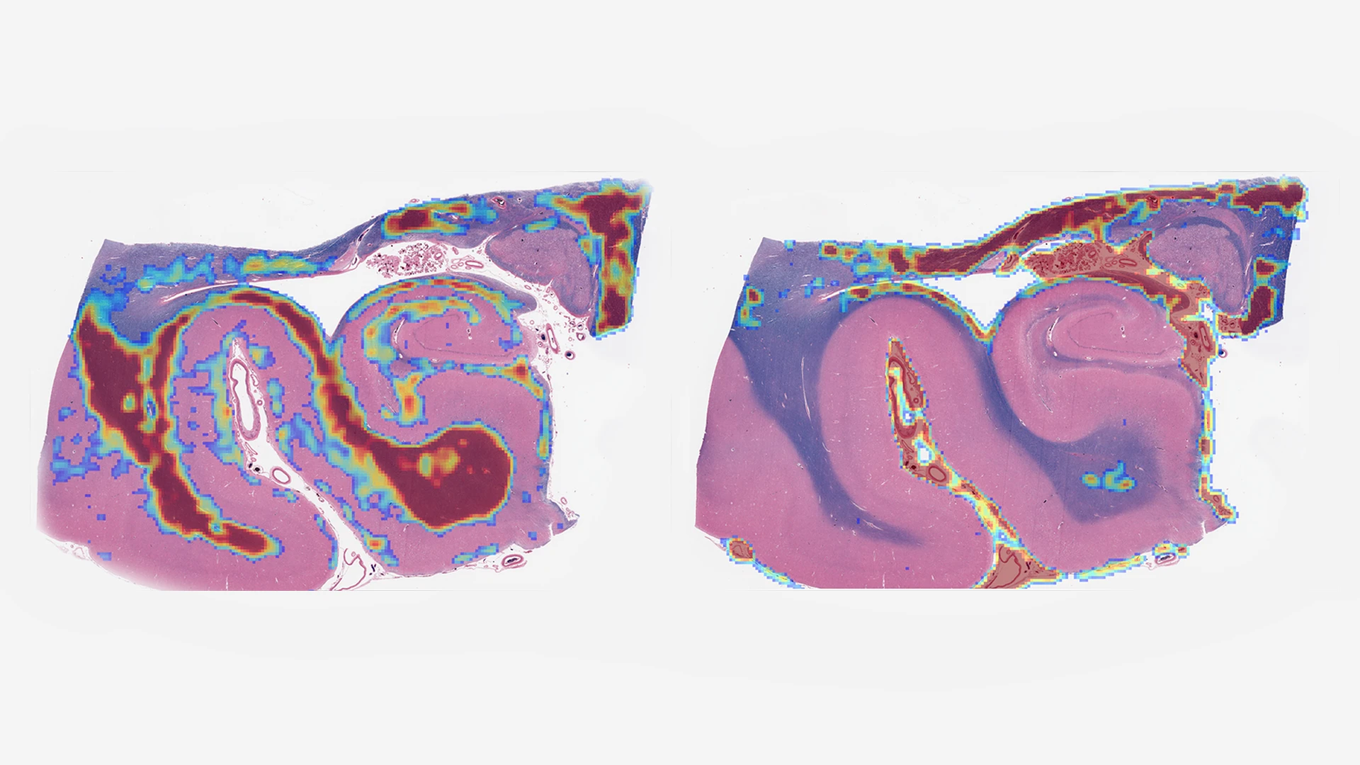 Figure 1. Digital whole-slide images of a human hippocampus analyzed using an age-acceleration algorithm developed by Gabriel Marx, MD, a research track Neurology resident at Mount Sinai. The Rainwater Charitable Foundation is funding Mount Sinai investigators to use AI to measure histological features too complex or subtle for human observers.