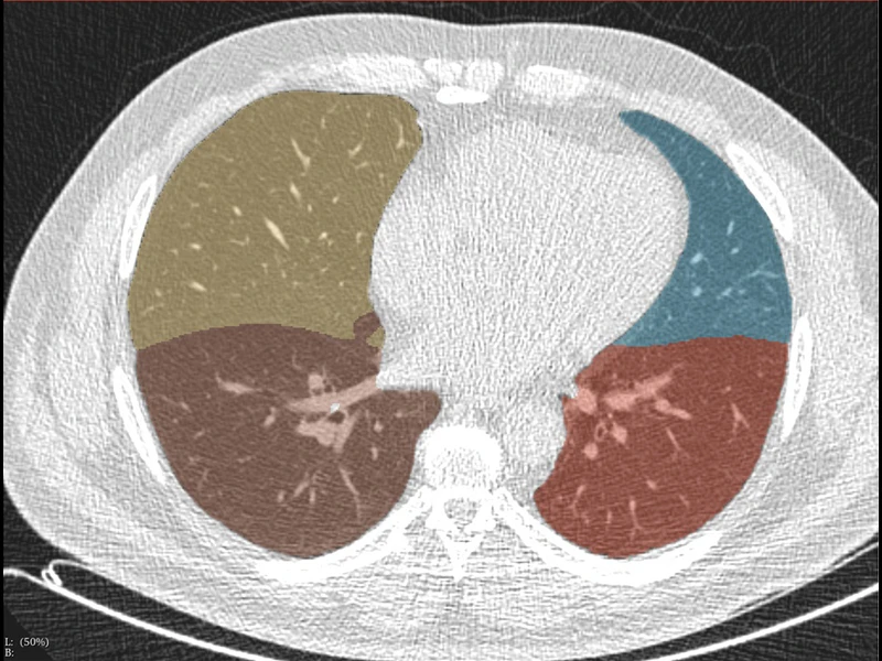 The automated image reading system (AIRS) applies a deep learning AI lung and lobe segmentation algorithm to a low-dose CT lung scan. The lung nodule detection AI algorithm identifies actionable lung nodules within the lung segmentation region of a CT scan by giving a 3D location.