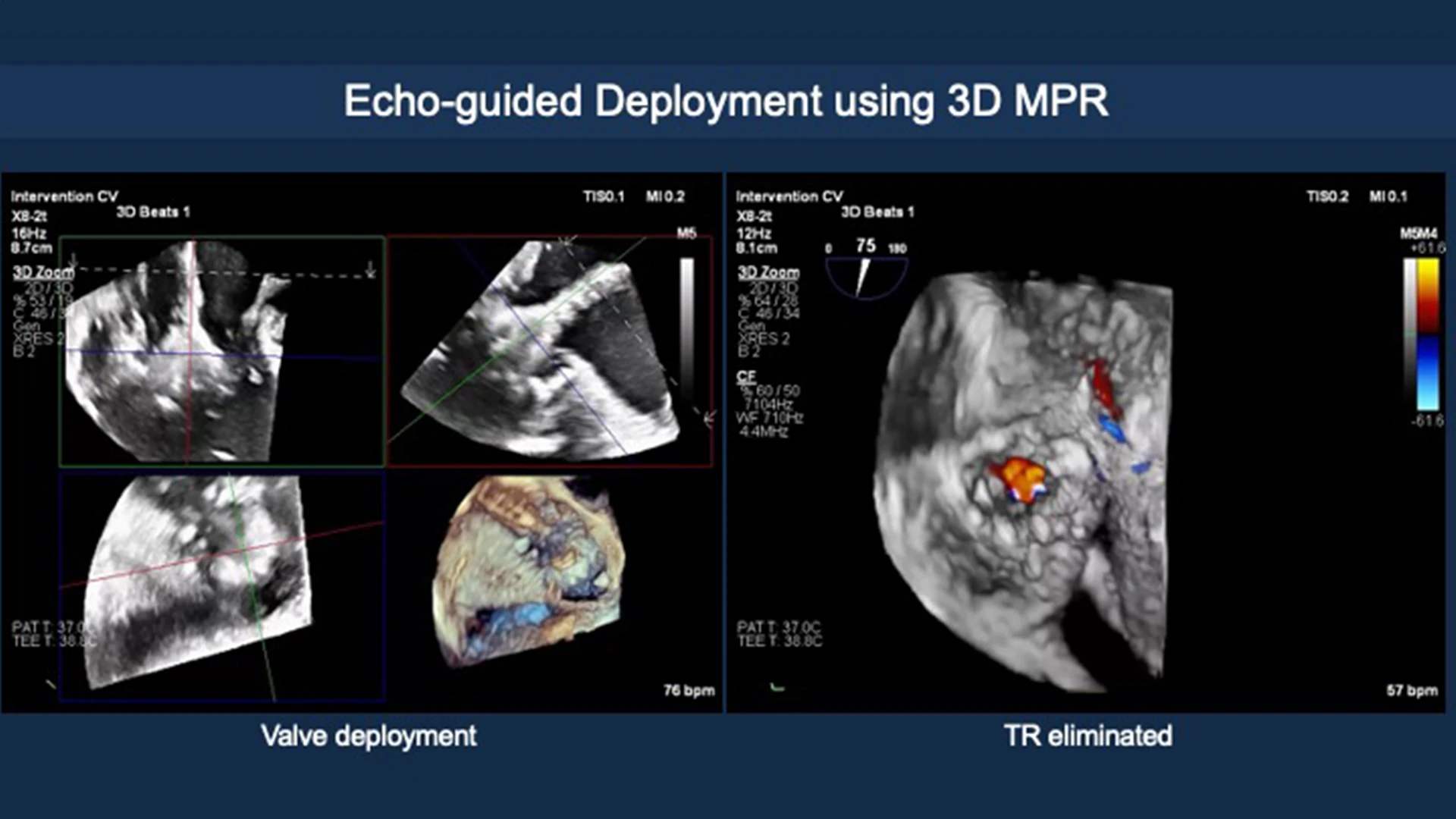 Deployment using 3-D multiplanar reconstruction. 