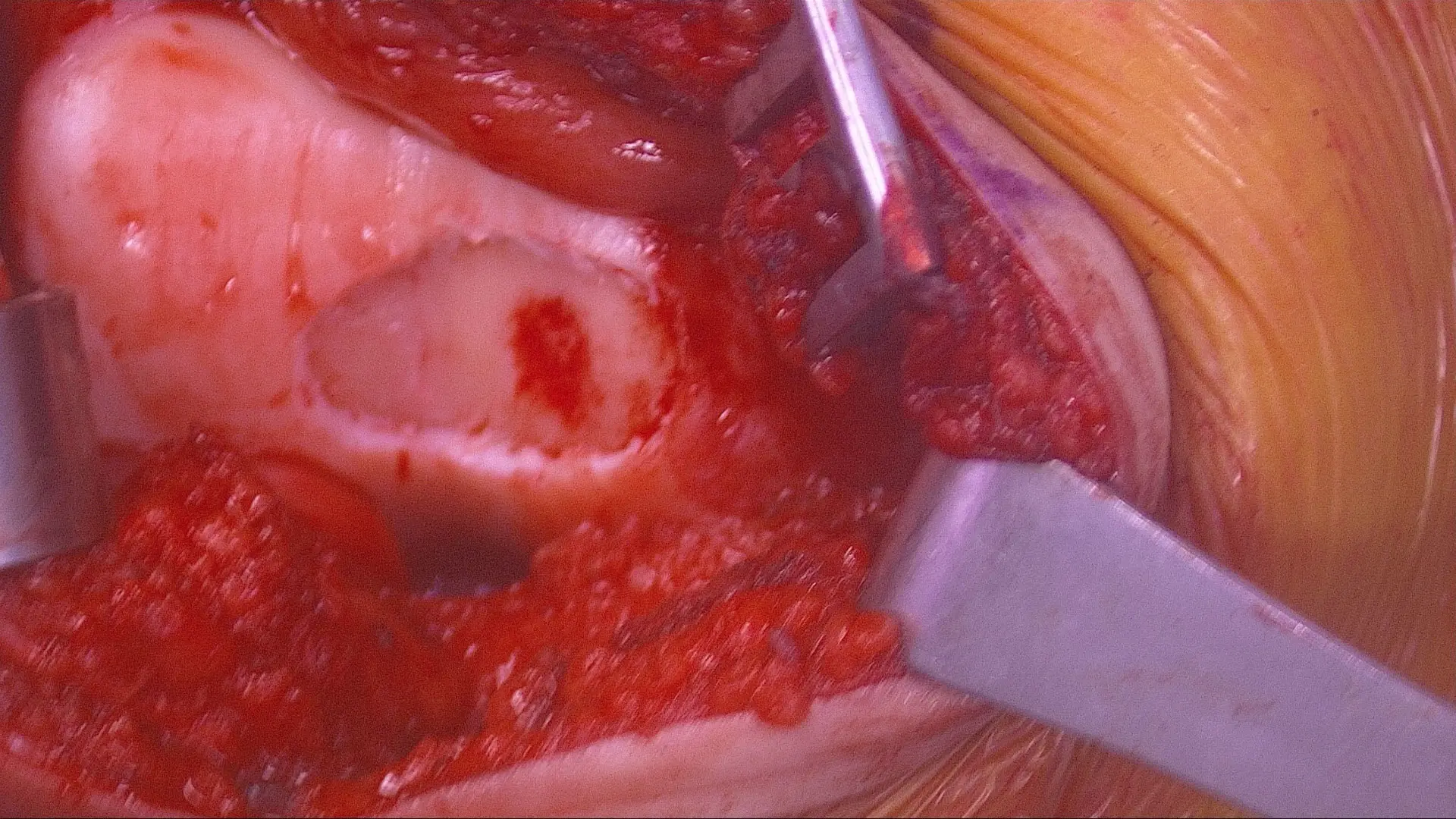Preparation of the defect by removing all the damaged cartilage down to bone.