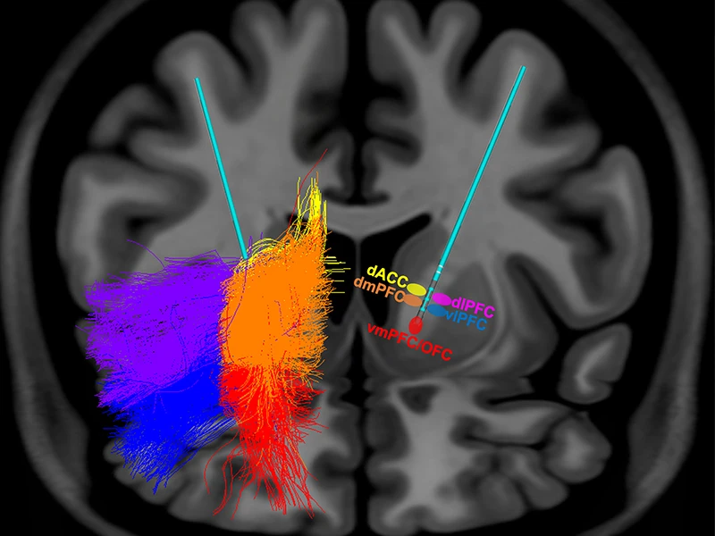 This image highlights symptom and circuit selective stimulation in deep brain stimulation (DBS) for obsessive-compulsive disorder. The colored areas represent the selective white matter tracts impacted by stimulation at respective contacts on the DBS electrode. 





