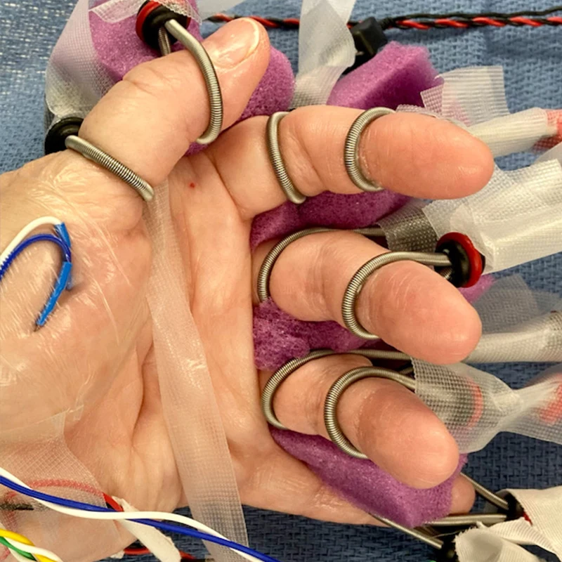 Middle Left. Left hand of the patient with bipolar ring-type stimulating electrodes on each finger to enable synchronized finger-level electrical stimulation and to identify the corresponding finger-specific somatosensory-evoked potentials on the cortical surface. 