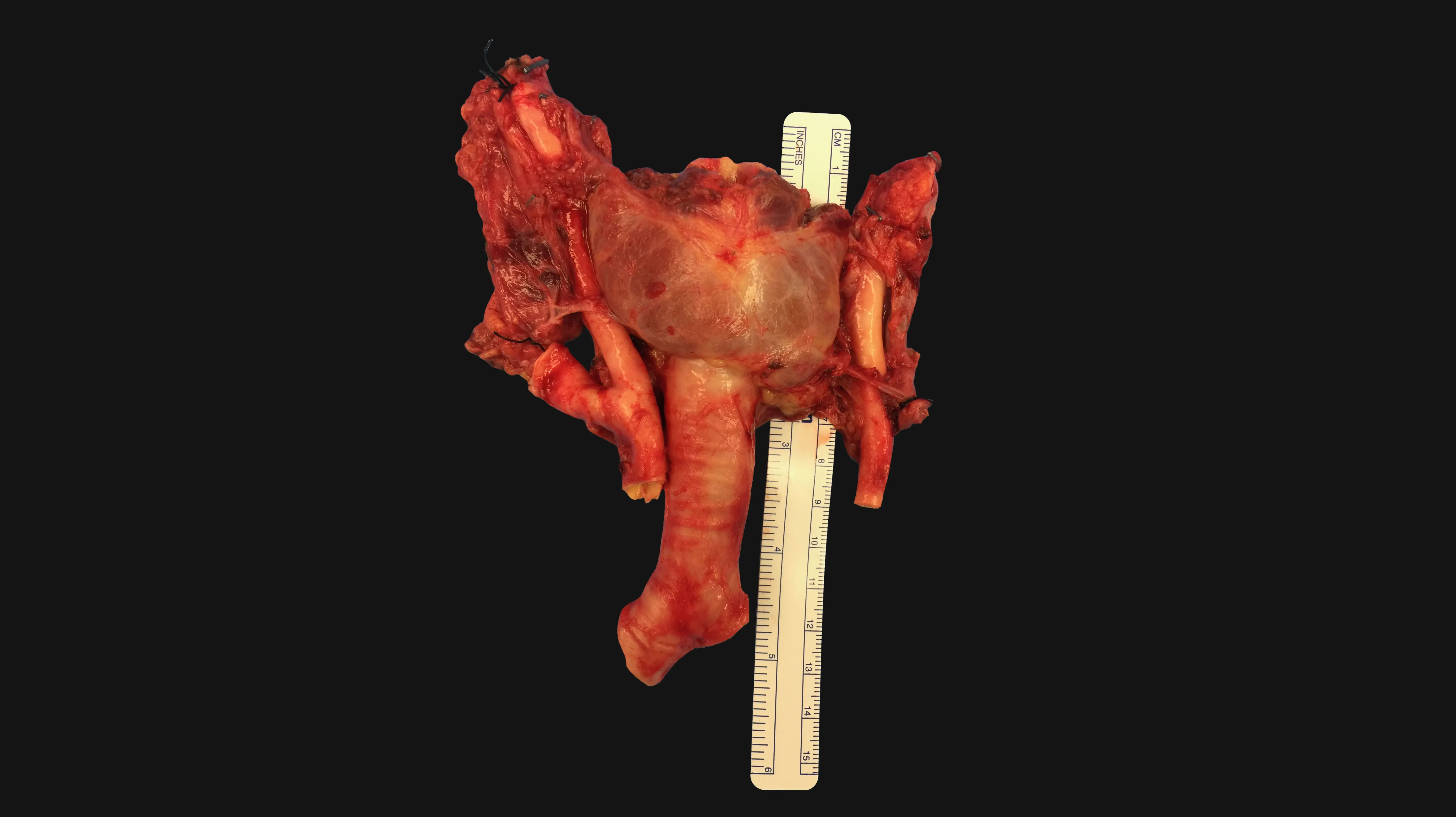 Thirty Years of Research Leads the Way to Revascularizing the Trachea 