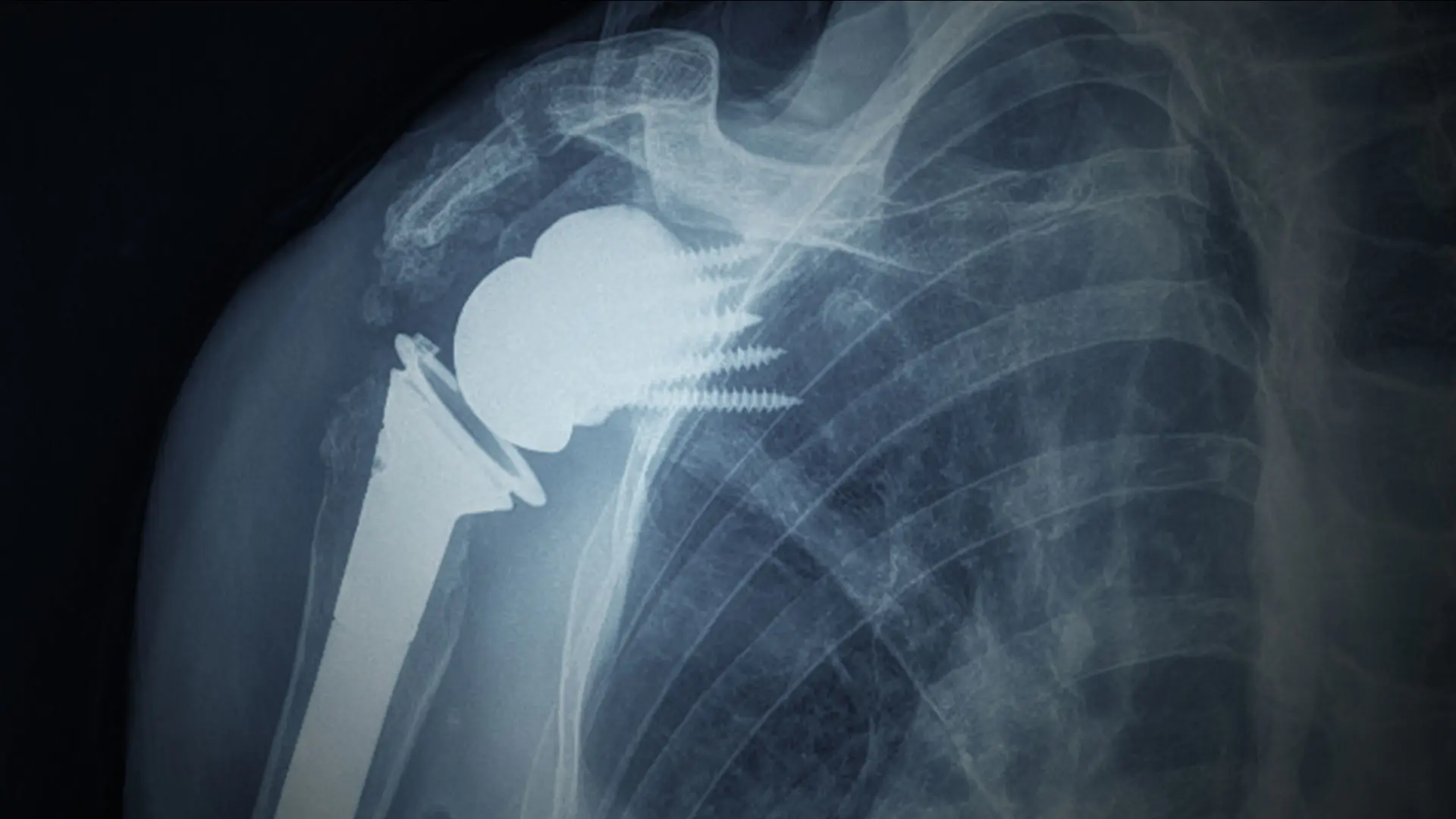 Advancing Shoulder Arthroplasty With 3D Technology